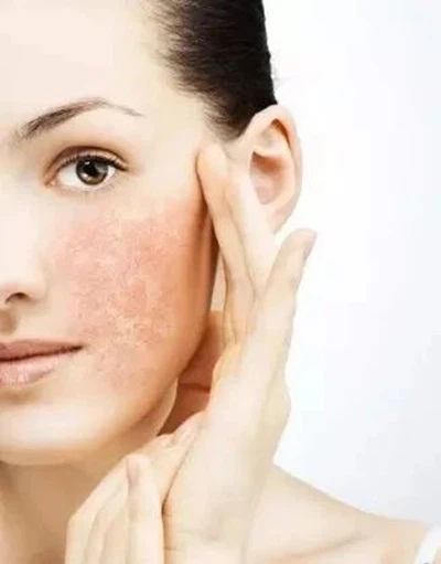 Cases with acne combined with sensitive skin Cases with acne combined with sensitive skin